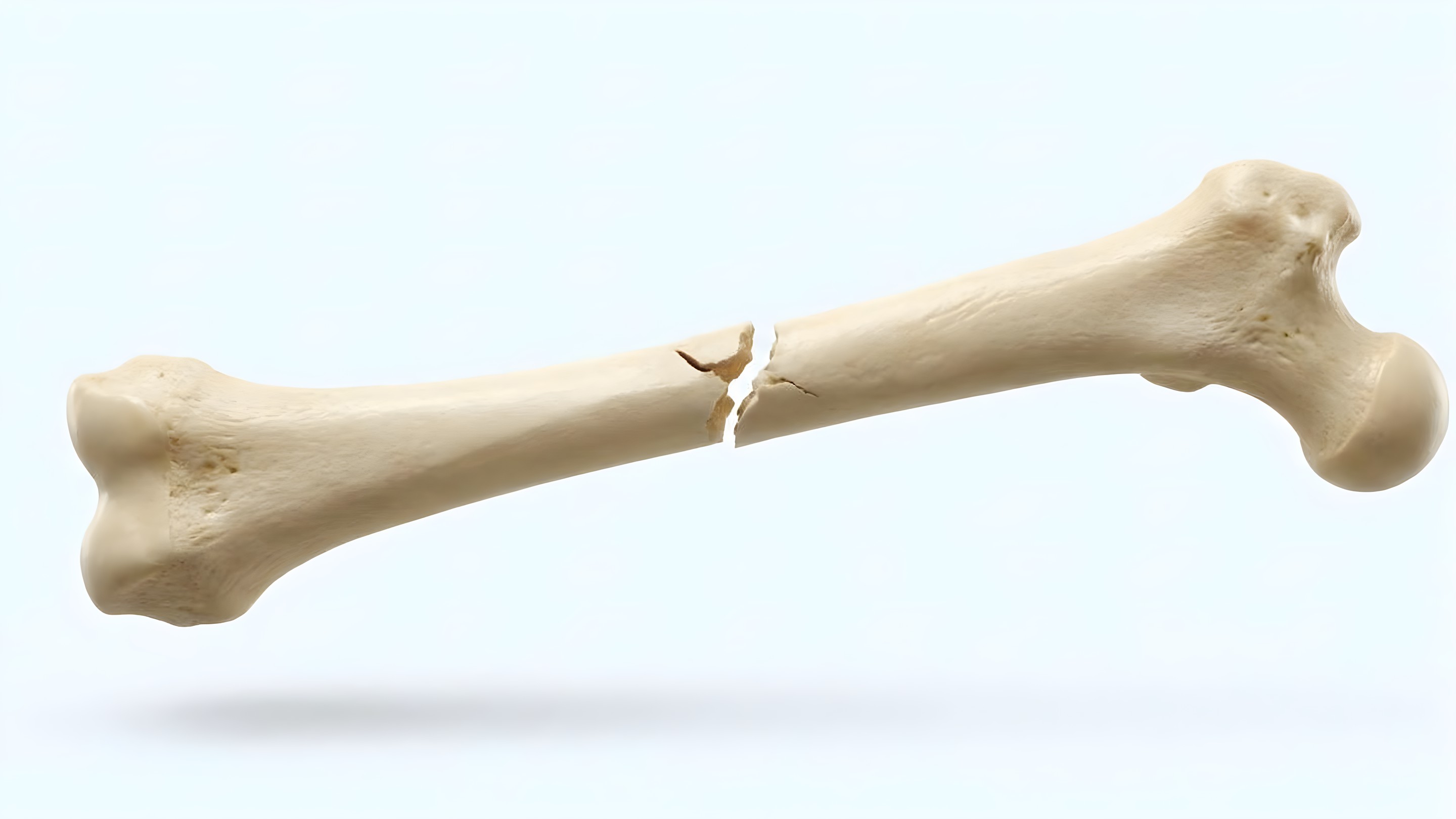 Fractured femur healing into a skeleton
