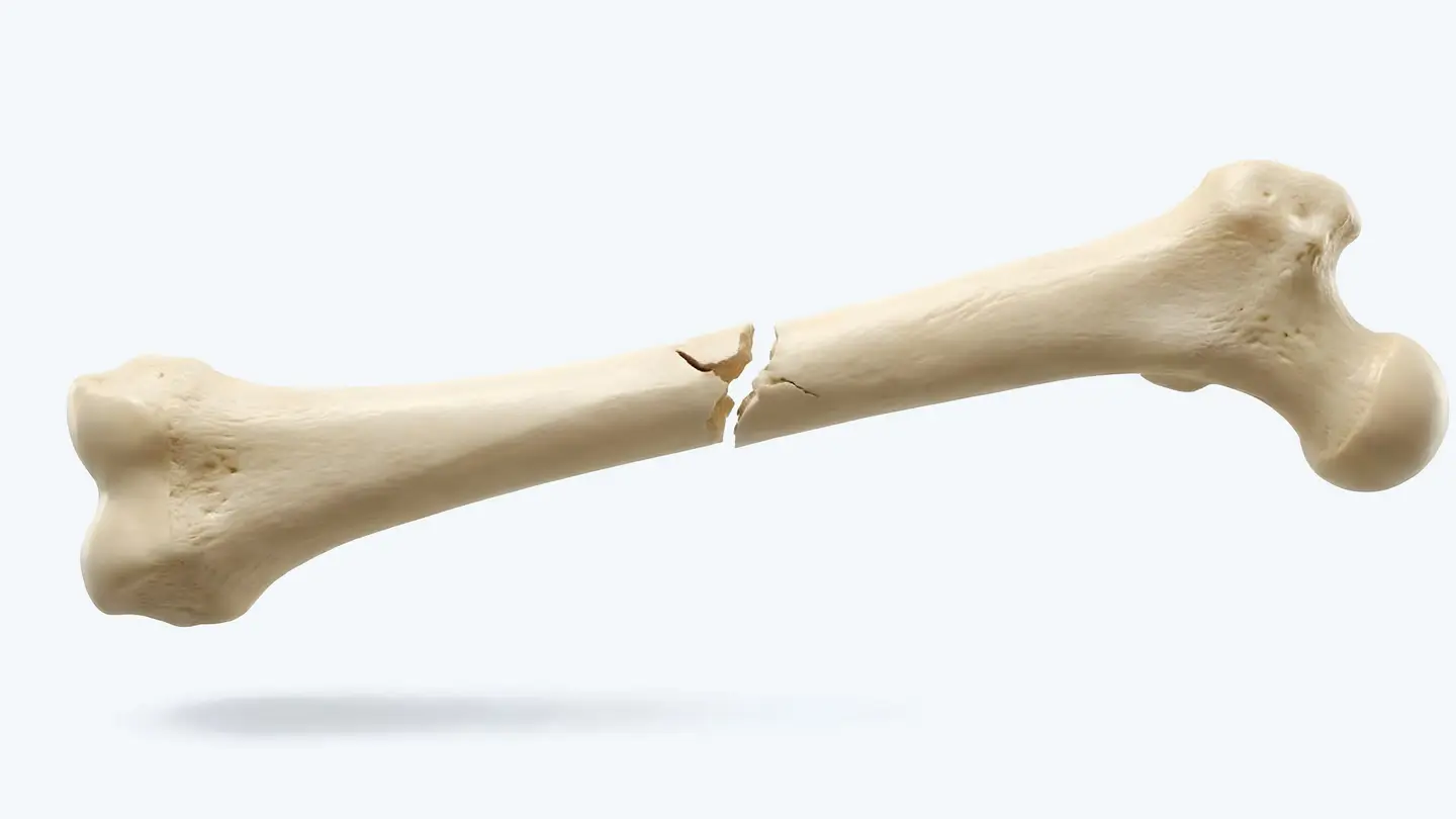 Fractured femur healing into a skeleton